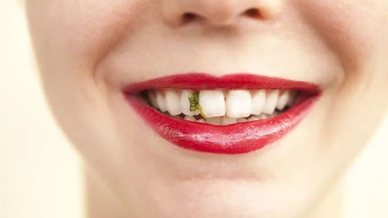 Thức ăn dễ bị kẹt trong khẽ hở răng sứ Thức ăn dễ bị kẹt trong khẽ hở răng sứ